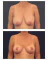 Breast Lift / Mastopexy