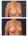 Breast Lift / Mastopexy