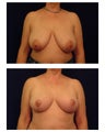 Breast Lift / Mastopexy