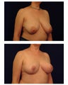Breast Lift / Mastopexy
