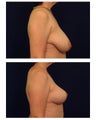 Breast Lift / Mastopexy