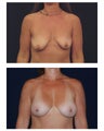 Breast Augmentation with Lift