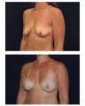 Breast Augmentation with Lift