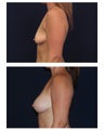 Breast Augmentation with Lift