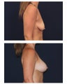 Breast Augmentation with Lift