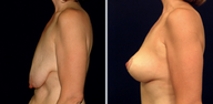 Breast Lift