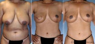 Breast reconstruction