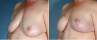 Breast reconstruction