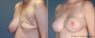 Breast reconstruction