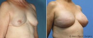 Breast reconstruction