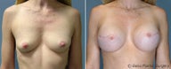 Breast reconstruction