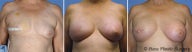 Breast reconstruction
