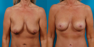 Breast lift and implants