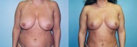 Breast Lift & Reduction