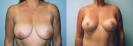 Breast Lift / Breast Augmentation