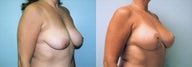 Breast Lift / Breast Augmentation