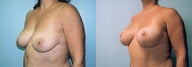 Breast Lift / Breast Augmentation