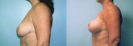 Breast Lift / Breast Augmentation
