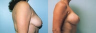 Breast Lift / Breast Augmentation