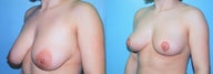 Vertical Mastopexy (Breast Lift with Nipple Reduction)