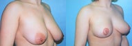 Vertical Mastopexy (Breast Lift with Nipple Reduction)