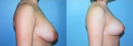 Vertical Mastopexy (Breast Lift with Nipple Reduction)