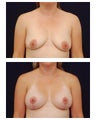 Augmentation Mastopexy