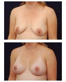 Augmentation Mastopexy