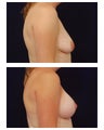 Augmentation Mastopexy