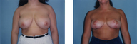 Breast Reduction