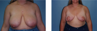 Breast Reduction
