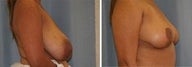46 year old/ 6 months post breast reduction