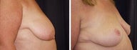 59 year old / breast reduction