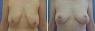 48 years old / Status post gastric bypass, breast reduction