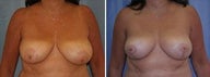 53 years old / breast reduction vertical technique