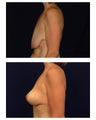 Breast Lift / Mastopexy