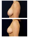 Augmentation Mastopexy