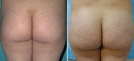 Buttock Augmentation