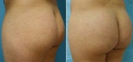 Buttock Enhancement