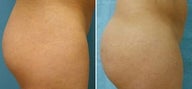 Buttock Augmentation