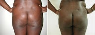 Buttock Enhancement