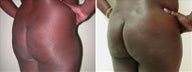 Buttock Augmentation
