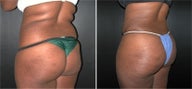 Buttock Augmentation