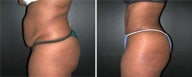 Buttock Augmentation