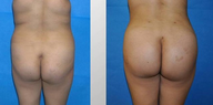 Buttock augmentation by fat transfer