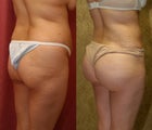 butt augmentation