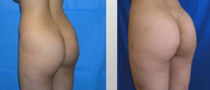 Butt Augmentation