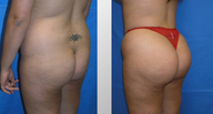 Butt Augmentation