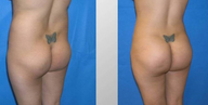 Butt Augmentation