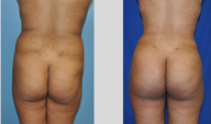 Buttock Augmentation